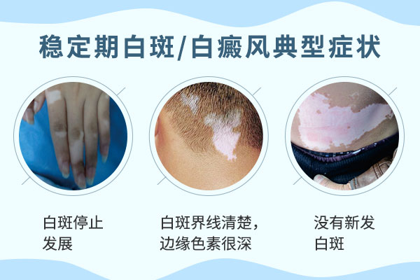 解析白癜风的症状表现及应对措施